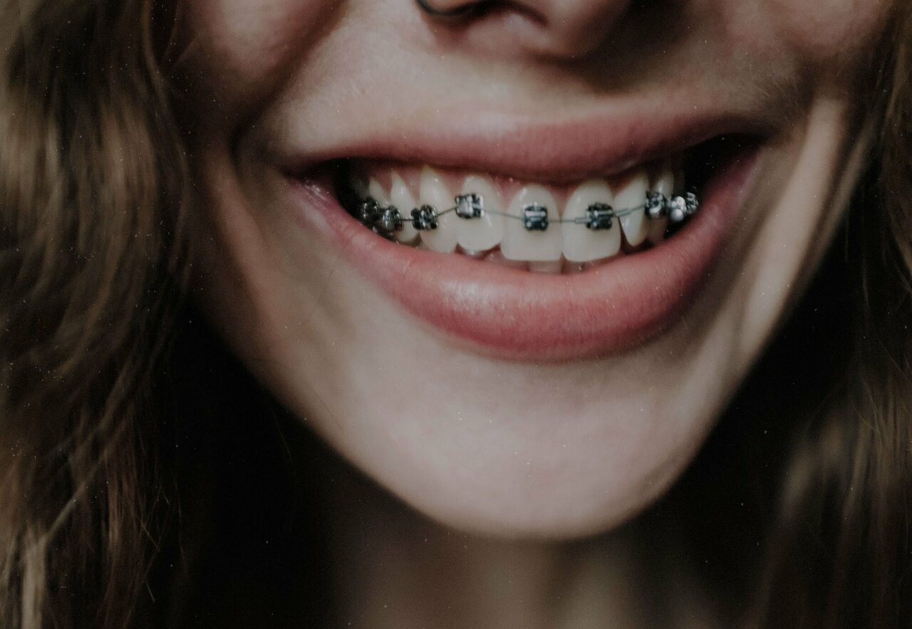 Ein Schub für das Selbstbewusstsein: Wie eine Zahnspange auch Ihr Leben verändern kann Image 2