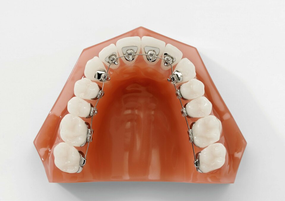 Zahnspange Oberkiefer